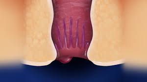 Image result for hemorrhoids