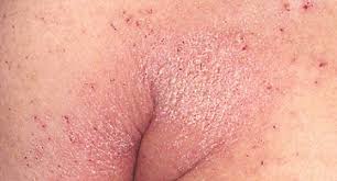 Image result for scabies in the groin area