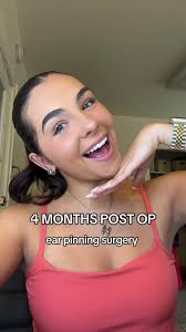Monthly ear check in!👂🏻 #surgerytiktok #surgery #surgeryrecovery  #otoplasty #earpinning #ears #earpinningsurgery