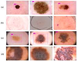 Diagnostics Free Full Text Skin Lesion Segmentation In