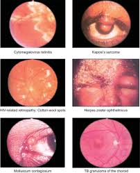 Image result for HIV Retinitis
