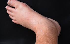 Left Foot and Ankle X-ray Oblique View No Bone Broken Soft Tissue No  Swelling. Stock Image