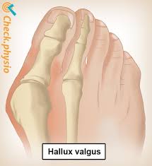 Image result for Hallux Varus