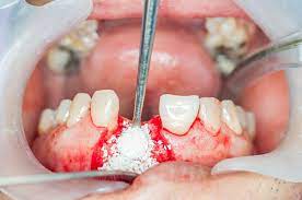 Before we get into how long it takes to recover from the procedure, it is important to understand what goes on during it. Dental Bone Graft Tips For After Care And Reduce The Complications