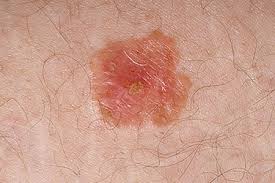 Most common on the back of men and legs of women. Skin Cancer Photos What Skin Cancer Precancerous Lesions Look Like