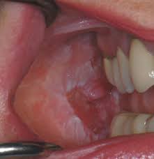 What does early signs of tongue cancer look like? Lesion Guide Oral Cancer Learning Hub