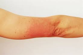 Image result for skin rash acute hiv infection