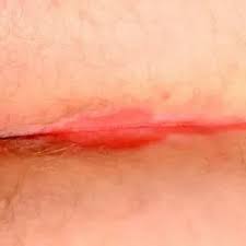 Image result for Intertrigo under breasts