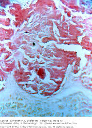 Amyloidosis is a collection of diseases that result from misfolded proteins becoming insoluble and aggregating in the extracellular matrix. Congo Red Stain For Amyloid Protein Oncohema Key