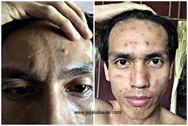 In scientific term the chickenpox is known as the varicella which is caused by the virus known as the varicella zoster which causes infection in the body and that leads to. Hilangkan Parut Chicken Pox Untuk Orang Dewasa Jejakakaula