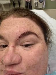 Softball injury requires 7 stitches