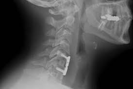 Tratamiento maternity excitación cervicales inflamados. Radiculopatia Cervical O Nervio Pinzado