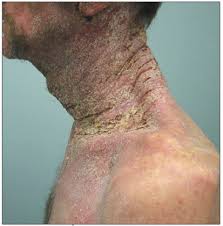 Image result for scabies human bites