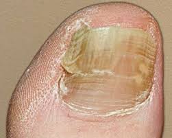 Feb 15, 2001 · psoriasis, lichen planus, contact dermatitis, trauma, nail bed tumor and yellow nail syndrome may be mistakenly diagnosed as onychomycosis.1, 2 a fungal etiology is unlikely if all fingernail or. How To Tell The Difference Between Toenail Fungus And Injury Toenail Fungus Home Remedies Toenail Fungus Toenail Fungus Medication