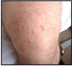 What does a meningitis rash look like? Diabetes Skin Rash On Hands Shefalitayal