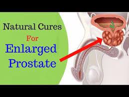 6 Effective Home Remedies To Treat Prostate Enlargement Enlarged Prostate Prostate Natural Cures