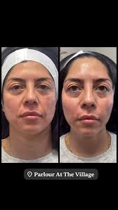 The Sculptra is Sculpting! Only a few days left to take advantage of our  Sculptra Savings! If you already know you love it, holler at me to lock  down your pricing! If you’re not sure if you need ...