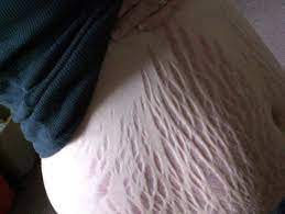 Stretch Marks Everything You Need To Know Manvfat Weight Loss Forum Man V Fat