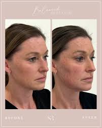 Balanced @ Bloom 🌸 Where artistry meets expertise. This experience is all  about facial harmony using undetectable injectables to refresh your look  while keeping it natural. Filler done right restores proportion, symmetry,