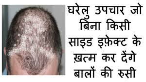 Often associated with other skin problems, and in youngsters either with acne or the general hormonal upheaval of. Howto How To Get Rid Of Dandruff And Hairfall In Hindi