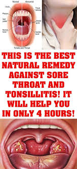 This Is The Best Natural Remedy Against Sore Throat And Tonsillitis It Will Help You In Only Best Sore Throat Remedies Tonsilitis Remedy Sore Throat Remedies