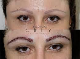 Eyebrow growth process after your surgery. Nyc Eyebrow Restoration New York Eyebrow Hair Transplant Ues