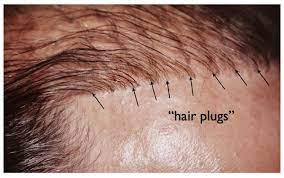 About 2 months after the hair transplant surgery you can dye your hair again. Hair Transplant Limitations Ny Hair Loss