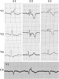 Image result for Epsilon Wave