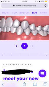 This site is not about teasing people with gaps in their teeth, though the tone here is lighthearted and sometimes irreverent. Not Sure About The End Result Closing A Front Tooth Gap And Both Side Look Like This Hoping Someone Has Experience In This Thanks Smiledirectclub