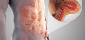 A patient's health affects the time it takes to recover from hernia mesh surgery. Recovery After A Laparoscopic Inguinal Hernia Surgery Laparoscopic Surgeon