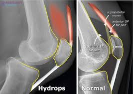 Image result for Knee XRay
