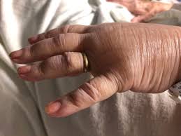 Image result for Ring Removal