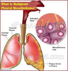 Pleural mesothelioma is a rare type of cancer caused by asbestos exposure. What Is Malignant Pleural Mesothelioma Causes Signs Symptoms