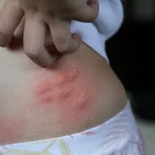 Image result for bedbugs bites
