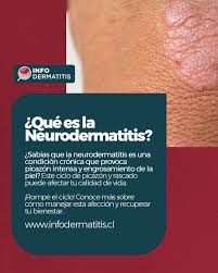 Image result for Neurodermatitis