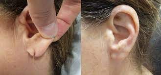 They involve using sutures to close the edges of the wound on the front and back of the earlobe. Earlobe Repair Fairfield County Connecticut