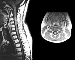Image result for Myelitis