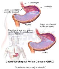 Gastroesophageal Reflux Diseases Series Of Cardiology Research Gastroesophageal Reflux Disease Reflux Disease Cardiology