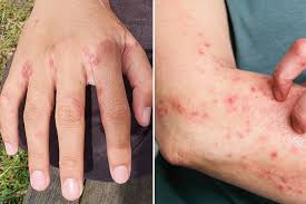 Image result for scabies symptoms