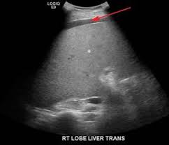 Image result for Adynamic Ileus