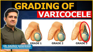 Image result for Varicocele
