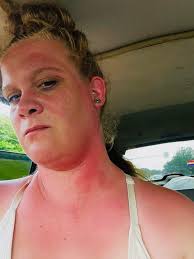 Any natural ways to remove poison sumac?