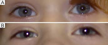 Isolated Horner Syndrome And Syringomyelia In A Child Journal Of American Association For Pediatric Ophthalmology And Strabismus Jaapos