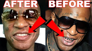 Much has been made of artist id=510062lil wayne's/artist surprising adjournment in a new york but according to an atlanta dentist who has worked with patients with grills, the new orleans mc's condition is anything but routine. Birdman Takes Off His Grillz Proof Youtube