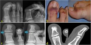 Image result for Interphalangeal Dislocation