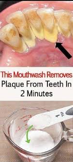 Can You Remove Tartar At Home Mouthwash Oral Care How To Remove