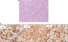 Marginal zone lymphoma is a form of lymphoma that is of low aggressiveness and indolent. it refers to the cell of origin of the tumor having come fr. Shades Of Gray Between Large B Cell Lymphomas And Hodgkin Lymphomas Differential Diagnosis And Biological Implications Modern Pathology