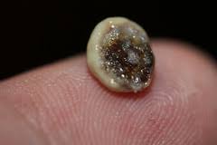 Eschara) is a slough or piece of dead tissue that is cast off from the surface of the skin, particularly after a burn injury, but also seen in gangrene, ulcer, fungal infections, necrotizing spider bite wounds, tick bites associated with spotted fevers, and exposure to cutaneous anthrax. Eschar Definition And Meaning