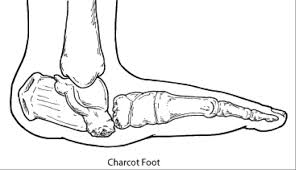The detailed pathomechanism of the disease is still unclear. Solutions Charcot Arthropathy Crary Shoes
