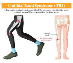 Image result for Knee Bulge Sign